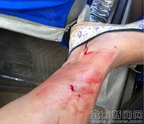 狗咬人咬出血是什么原因