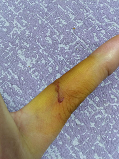 狗咬人流血是什么症状